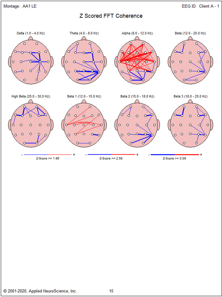Z-scored FFT coherence maps showing frontal hypercoherence and focal hypocoherence